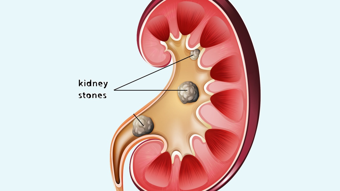 What causes kidney stones (and what to do)