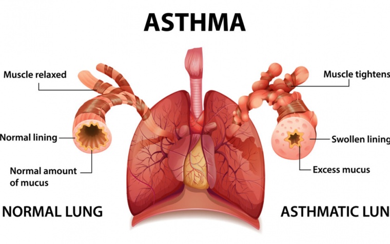 World Asthma Day: Asthma Education Empowers